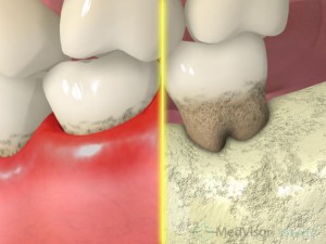 第4段階　中程度の歯周炎